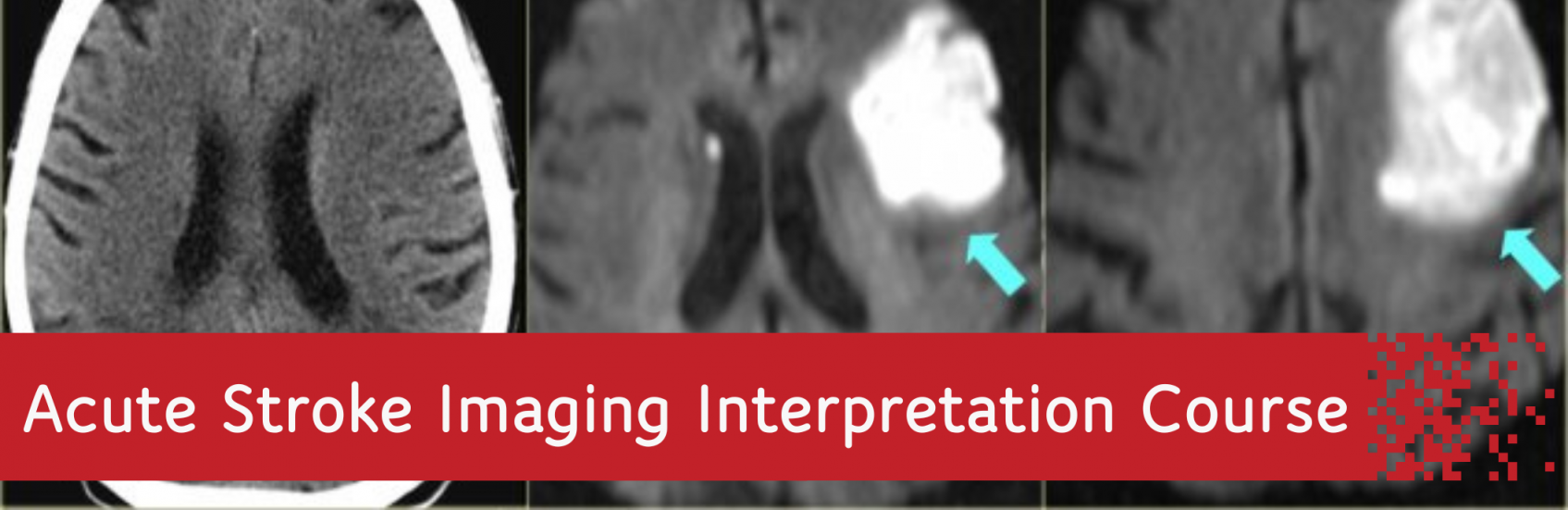 NIAW - Acute Stroke Imaging Interpretation Course